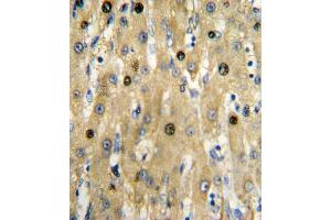 Formalin-fixed and paraffin-embedded human hepatocarcinoma reacted with PKM1 Antibody (C-term ), which was peroxidase-conjugated to the secondary antibody, followed by DAB staining. (PKM1 (AA 383-417), (C-Term) Antikörper)