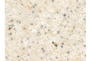 ABIN6255542 and ABIN6267583 at 1/100 staining human astrocytoma by IHC-P.