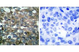 Peptide - +Immunohistochemical analysis of paraffin-embedded human breast carcinoma tissue using EGFR (Ab-869) antibody (#B7065).