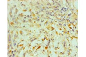 Immunohistochemistry of paraffin-embedded human melanoma using ABIN7164069 at dilution of 1:100 (OCT4 Antikörper  (AA 1-360))