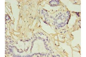 Immunohistochemistry of paraffin-embedded human breast cancer using ABIN7153819 at dilution of 1:100 (GGPS1 Antikörper  (AA 1-300))
