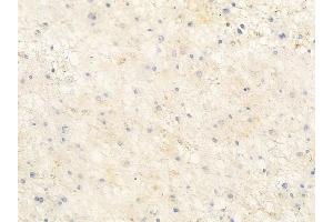 ABIN6263846 and ABIN6272717 at 1/100 staining human astrocytoma by IHC-P. (OR1L8 Antikörper  (C-Term))