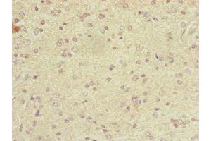 Immunohistochemistry of paraffin-embedded human glioma using ABIN7149326 at dilution of 1:100 (DYNC2LI1 Antikörper  (AA 1-352))