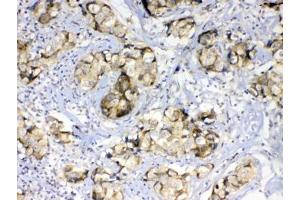 IHC testing of FFPE human breast cancer tissue with GALE antibody at 1ug/ml. (GALE Antikörper)