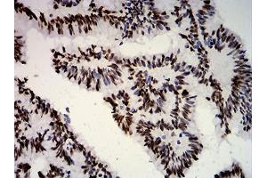 Immunohistochemical analysis of paraffin-embedded colon cancer tissues using ESR1 mouse mAb with DAB staining. (Estrogen Receptor alpha Antikörper  (AA 2-185))