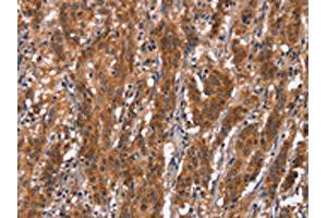 The image on the left is immunohistochemistry of paraffin-embedded Human gastric cancer tissue using ABIN7190842(GPHN Antibody) at dilution 1/30, on the right is treated with synthetic peptide. (Gephyrin Antikörper)