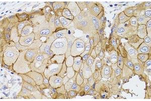 Immunohistochemistry of paraffin-embedded Human breast cancer using PDE4D Polyclonal Antibody at dilution of 1:100 (40x lens). (PDE4D Antikörper)