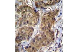 Formalin fixed, paraffin embedded human breast carcinoma stained with RNF11 Antibody (Center) followed by peroxidase conjugation of the secondary antibody and DAB staining