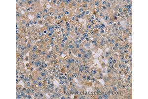Immunohistochemistry of Human breast cancer using CLIC1 Polyclonal Antibody at dilution of 1:30 (CLIC1 Antikörper)