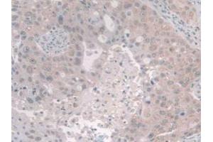 IHC-P analysis of Human Breast Cancer Tissue, with DAB staining. (NCOA3 Antikörper  (AA 1023-1304))