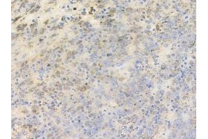 ABIN6256017 and ABIN6267403 at 1/100 staining human melanoma by IHC-P. (Phospholipase C gamma 2 Antikörper  (pTyr753))