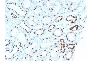Formalin-fixed, paraffin-embedded human Renal Cell Carcinoma stained with PAX8 Mouse Monoclonal Antibody (PAX8/1492). (PAX8 Antikörper  (AA 60-261))