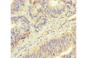 Immunohistochemistry of paraffin-embedded human colon cancer using ABIN7168424 at dilution of 1:100