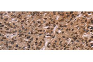 Immunohistochemistry of paraffin-embedded Human liver cancer tissue using LMNB1 Polyclonal Antibody at dilution of 1:60(x200) (Lamin B1 Antikörper)