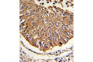 Formalin-fixed and paraffin-embedded human lung carcinoma reacted with MDH2 Antibody (Center), which was peroxidase-conjugated to the secondary antibody, followed by DAB staining. (MDH2 Antikörper  (AA 86-115))