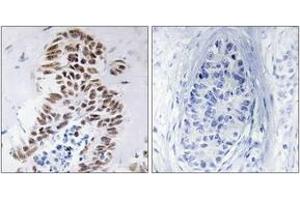 Immunohistochemistry analysis of paraffin-embedded human lung carcinoma tissue, using DAPK3 (Ab-265) Antibody. (DAPK3 Antikörper  (AA 241-290))