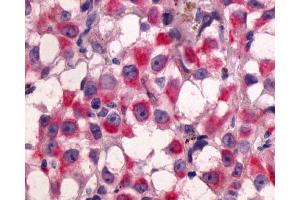 Anti-GPR64 antibody IHC of human Skin, Melanoma. (Adhesion G-Protein Coupled Receptor G2 (ADGRG2) (C-Term) Antikörper)