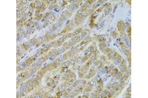 Immunohistochemistry of paraffin-embedded Human thyroid cancer using DLD Polyclonal Antibody at dilution of 1:100 (40x lens). (DLD Antikörper)