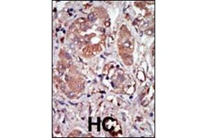 Formalin-fixed and paraffin-embedded human cancer tissue reacted with the primary antibody, which was peroxidase-conjugated to the secondary antibody, followed by DAB staining. (EIF2AK2 Antikörper  (C-Term))