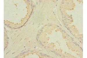 Immunohistochemistry of paraffin-embedded human prostate cancer using ABIN7174924 at dilution of 1:100 (CXorf21 Antikörper  (AA 1-301))