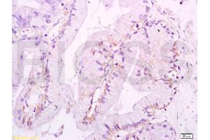 Formalin-fixed and paraffin embedded human endometrium carcinoma labeled with Anti-Ezrin Polyclonal Antibody, Unconjugated (ABIN675234) at 1:200 followed by conjugation to the secondary antibody and DAB staining. (Ezrin Antikörper  (AA 455-586))