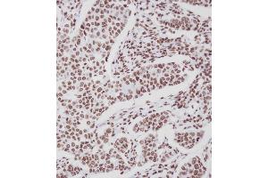 Immunohistochemical analysis of A on paraffin-embedded Human breast carcinoma tissue. (ERBB4 Antikörper  (pTyr1188))