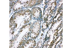 IHC-P: HSP10 antibody testing of human intestinal cancer tissue (HSPE1 Antikörper  (C-Term))