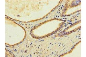 Immunohistochemistry of paraffin-embedded human prostate cancer using ABIN7173179 at dilution of 1:100 (TMEM255B Antikörper  (AA 221-356))