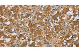 Immunohistochemistry of paraffin-embedded Human thyroid cancer tissue using FOXB1 Polyclonal Antibody at dilution 1:30 (FOXB1 Antikörper)