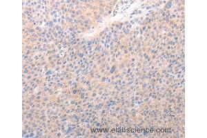 Immunohistochemistry of Human lung cancer using ACO1 Polyclonal Antibody at dilution of 1:50 (Aconitase 1 Antikörper)