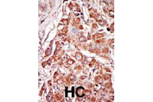 Formalin-fixed and paraffin-embedded human hepatocellular carcinoma tissue reacted with EIF2AK2 polyclonal antibody  , which was peroxidase-conjugated to the secondary antibody, followed by DAB staining. (EIF2AK2 Antikörper  (N-Term))