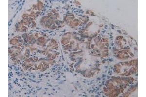 IHC-P analysis of Human Lung Cancer Tissue, with DAB staining. (AKT2 Antikörper  (AA 142-412))