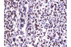 Formalin-fixed and paraffin embedded human breast carcinoma labeled with Anti-CDK6 Polyclonal Antibody (ABIN670236), Unconjugated at 1:200, followed by conjugation to the secondary antibody and DAB staining (CDK6 Antikörper  (AA 21-110))