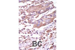 Formalin-fixed and paraffin-embedded human cancer tissue reacted with CAMK2A polyclonal antibody  , which was peroxidase-conjugated to the secondary antibody, followed by AEC staining. (CAMK2A Antikörper  (C-Term))