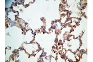 Rat lung cancer tissue stained by Rabbit Anti-CRAMP (Mouse) Antibody (Cathelicidin Antikörper  (AA 140-173))