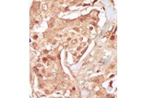 Formalin-fixed and paraffin-embedded human cancer tissue reacted with the primary antibody, which was peroxidase-conjugated to the secondary antibody, followed by DAB staining. (CDK18 Antikörper  (N-Term))