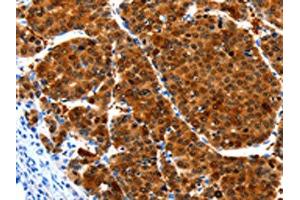 The image on the left is immunohistochemistry of paraffin-embedded Human liver cancer tissue using ABIN7190937(HIBADH Antibody) at dilution 1/25, on the right is treated with synthetic peptide.