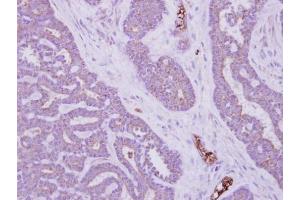 IHC-P Image Immunohistochemical analysis of paraffin-embedded human colon carcinoma, using MTMR14, antibody at 1:500 dilution. (MTMR14 Antikörper)