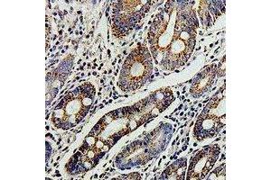 Immunohistochemical analysis of TERE1 staining in human colon cancer formalin fixed paraffin embedded tissue section. (UBIAD1 Antikörper)