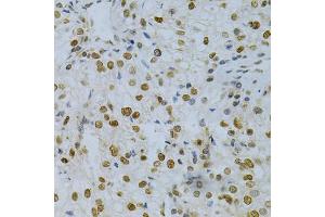Immunohistochemistry of paraffin-embedded human kidney cancer using ELAVL1 Antibody (ABIN5970780) at dilution of 1/200 (40x lens). (ELAVL1 Antikörper)