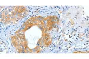 Immunohistochemistry of paraffin-embedded Human cervical cancer using ASNS Polyclonal Antibody at dilution of 1:60 (Asparagine Synthetase Antikörper)