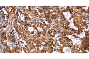 Immunohistochemistry of paraffin-embedded Human thyroid cancer tissue using HACE1 Polyclonal Antibody at dilution 1:40 (HACE1 Antikörper)