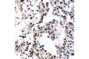 Immunohistochemistry of paraffin-embedded human lung cancer using ID3 antibody (ABIN6130481, ABIN6142140, ABIN6142141 and ABIN6221020) at dilution of 1:200 (40x lens). (ID3 Antikörper  (AA 1-119))