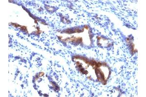 Formalin-fixed, paraffin-embedded human Gastric Carcinoma stained with MUC3 Mouse Monoclonal Antibody (M3. (MUC3A Antikörper)