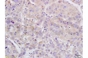 Formalin-fixed and paraffin embedded human brain glioma tissue labeled with Anti-Phospho-Wee1(Ser642) Polyclonal Antibody, Unconjugated (ABIN746873) at 1:200 followed by conjugation to the secondary antibody and DAB staining
