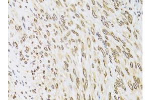 Immunohistochemistry of paraffin-embedded human uterine cancer using EMD antibody. (Emerin Antikörper)