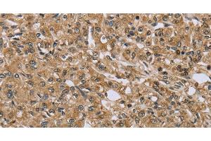 Immunohistochemistry of paraffin-embedded Human prostate cancer using TXLNA Polyclonal Antibody at dilution of 1:30 (alpha Taxilin Antikörper)