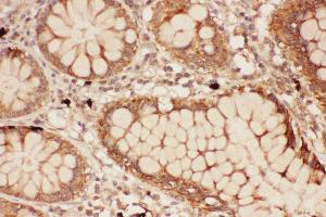Anti-ALOX15 Picoband antibody,  IHC(P): Human Intestine Cancer Tissue (ALOX15 Antikörper  (AA 2-337))