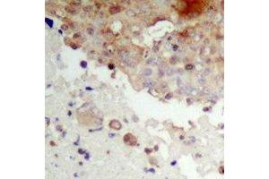 Immunohistochemical analysis of IKB epsilon (pS22) staining in human prostate cancer formalin fixed paraffin embedded tissue section. (NFKBIE Antikörper  (pSer22))