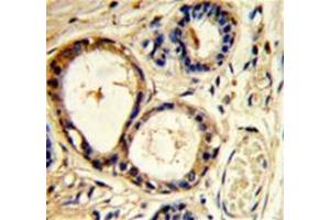 Immunohistochemistry analysis of human breast carcinoma (Formalin-fixed, Paraffin-embedded) using Cortactin (SRC8)  Antibody  (N-term), followed by  peroxidase-conjugated secondary antibody and DAB staining. (Cortactin Antikörper  (N-Term))